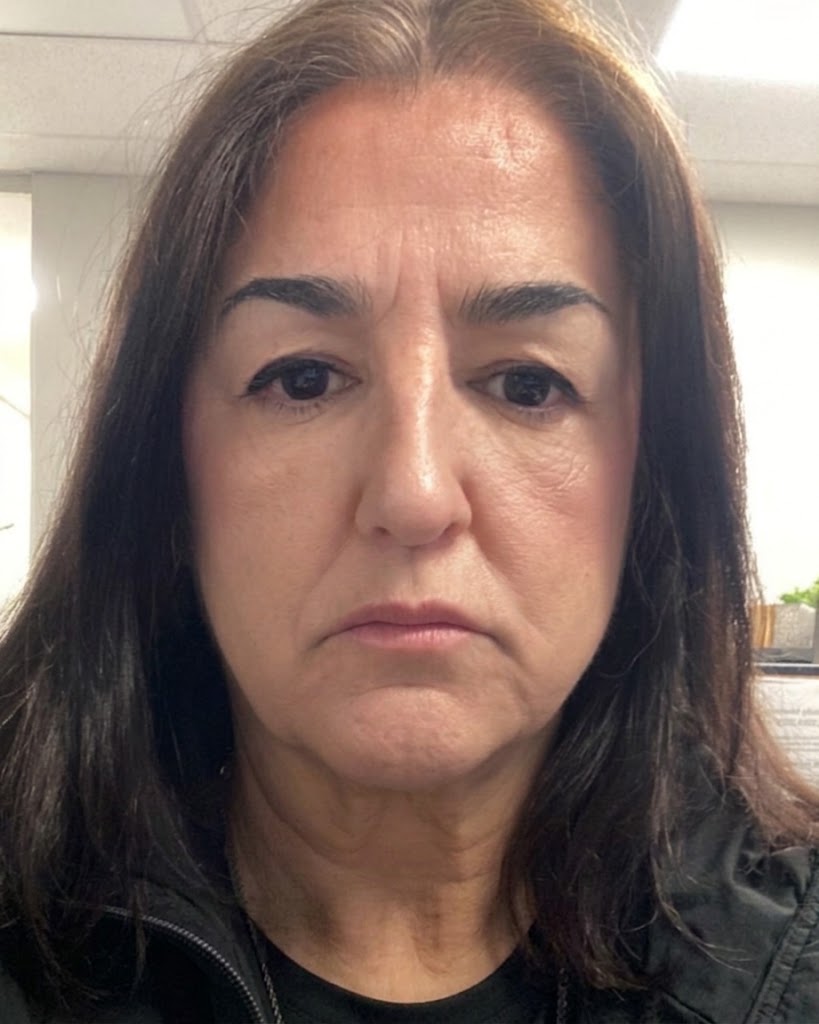 After &mdash; Deep Plane Face Lift in Mexico City, Argaman Plastic Surgeries Mexico